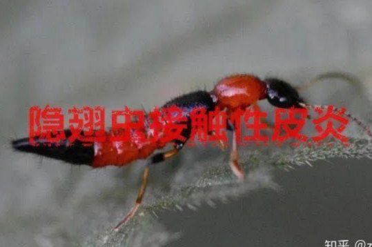 隐翅虫体液真的有毒吗？揭秘其真实毒性与影响